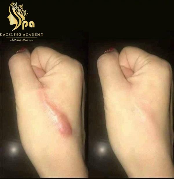 Hình ảnh trước và sau quá trình tiêm trị sẹo lồi tại Dazzling Academy Spa